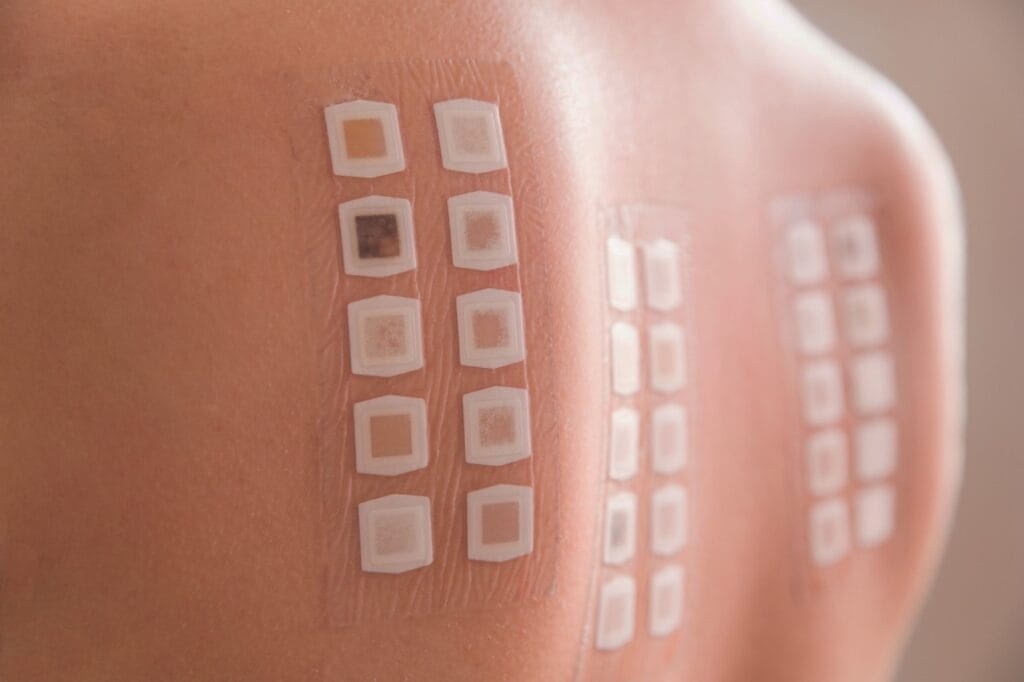 Patch testing grid on skin for latex allergy diagnosis